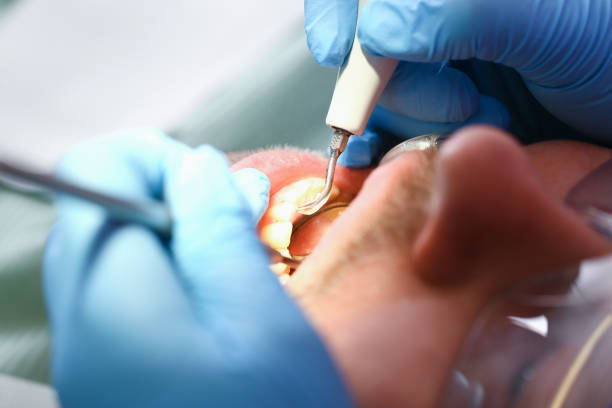 Best Emergency Dental Extractions in Underwood, IA
